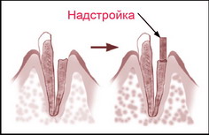 Метод апекслокации