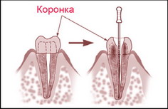 Апекслокатор